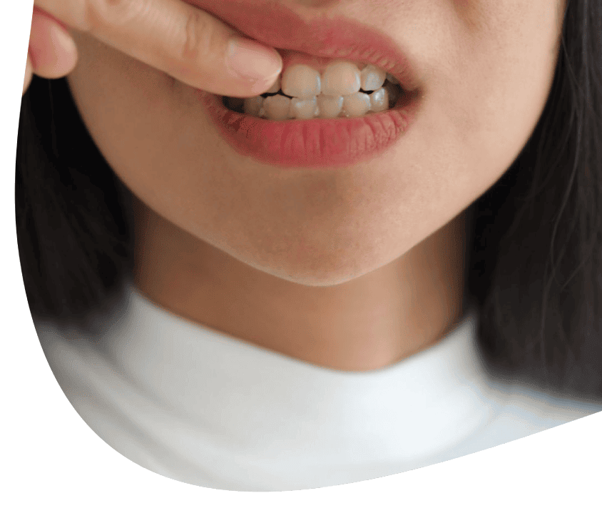 Biały nalot na zębach