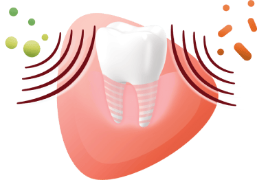 Ilustracja przedstawiająca ząb z implantem