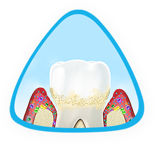 Zapalenie dziąseł (Gingivitis) Zapalenie dziąseł (Gingivitis)